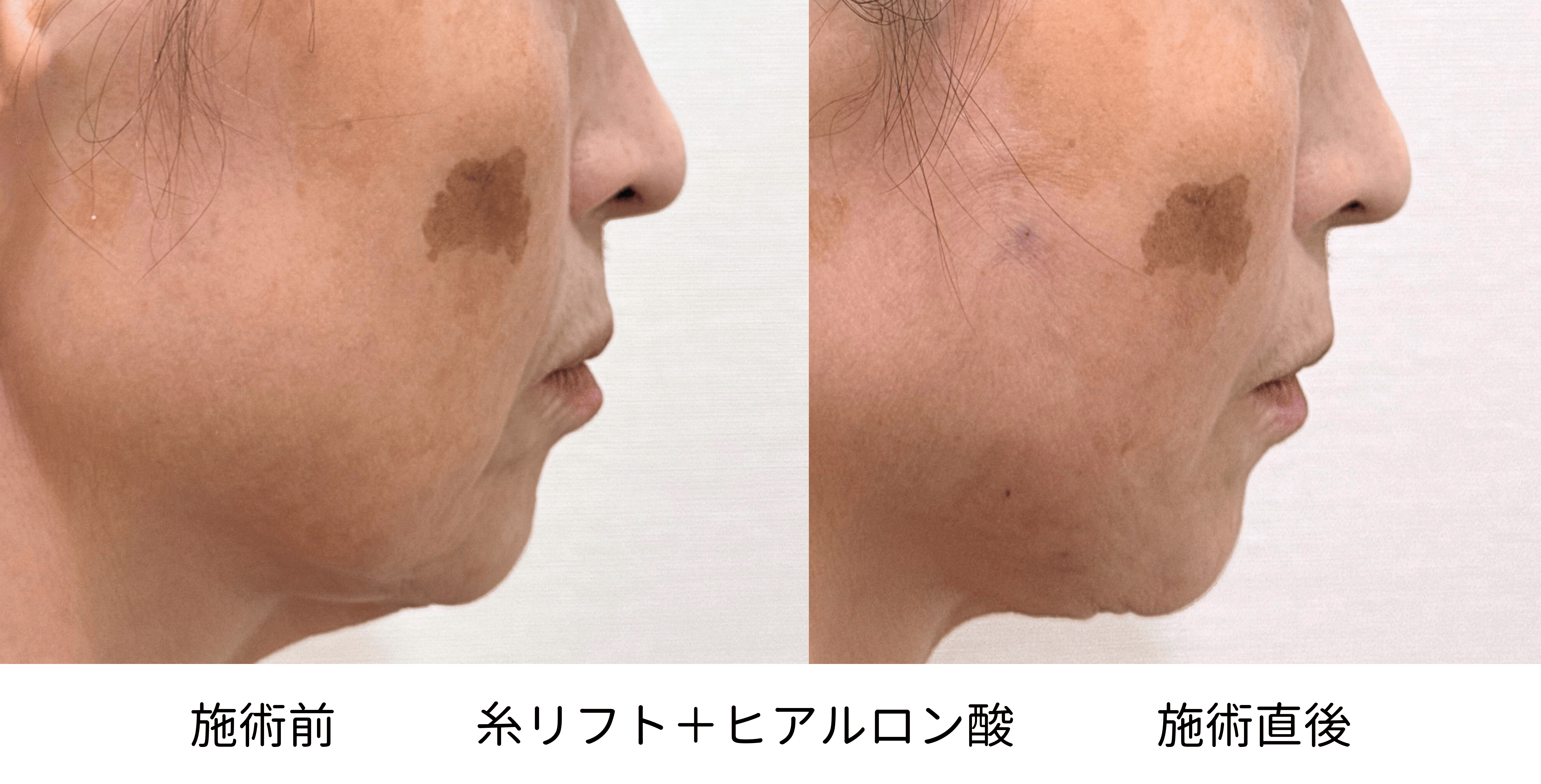 60代女性の糸リフトとヒアルロン酸治療前後の右側別比較