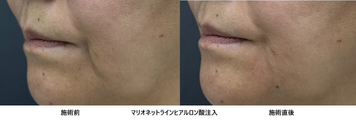 50代女性ヒアルロン酸によるマリオネットライン治療⑥の症例写真