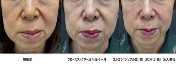 60代女性 症例10のほうれい線治療写真