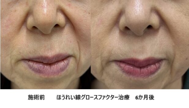 60代女性 症例9のほうれい線治療写真