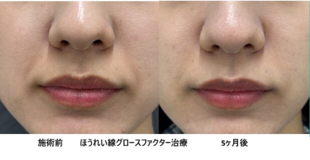 20代女性 症例14のほうれい線治療写真