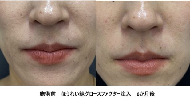 40代女性 症例43のほうれい線治療写真