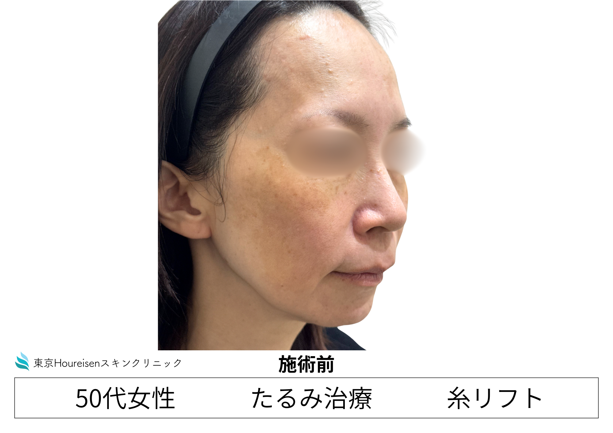 50代女性のPLCL糸リフト治療前 右側