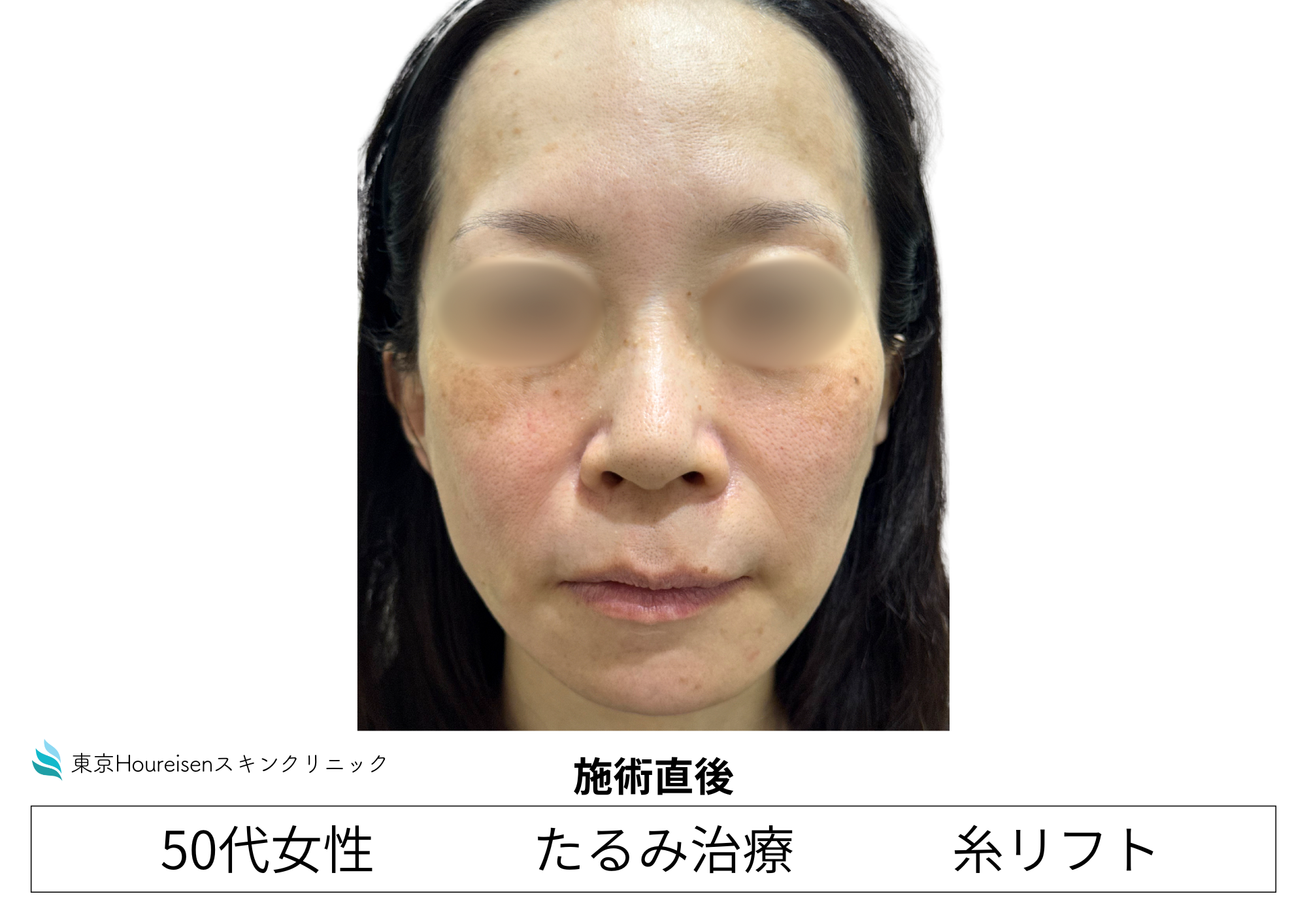 50代女性のPLCL糸リフト10本 施術直後 正面