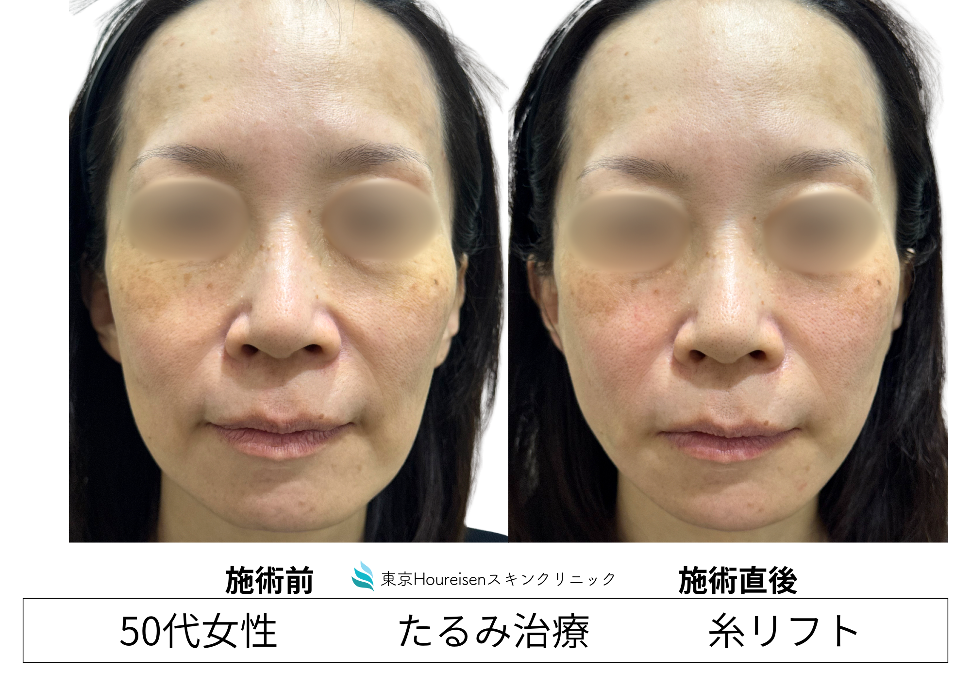50代女性、糸リフト（スレッドリフト）治療でフェイスラインをすっきりさせる。症例㉗の症例写真
