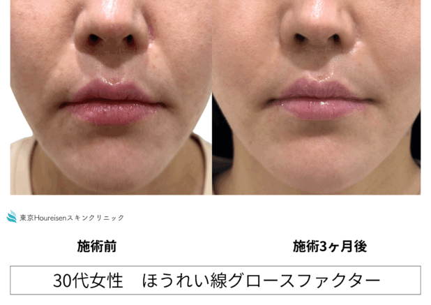 30代女性 症例39のほうれい線治療写真