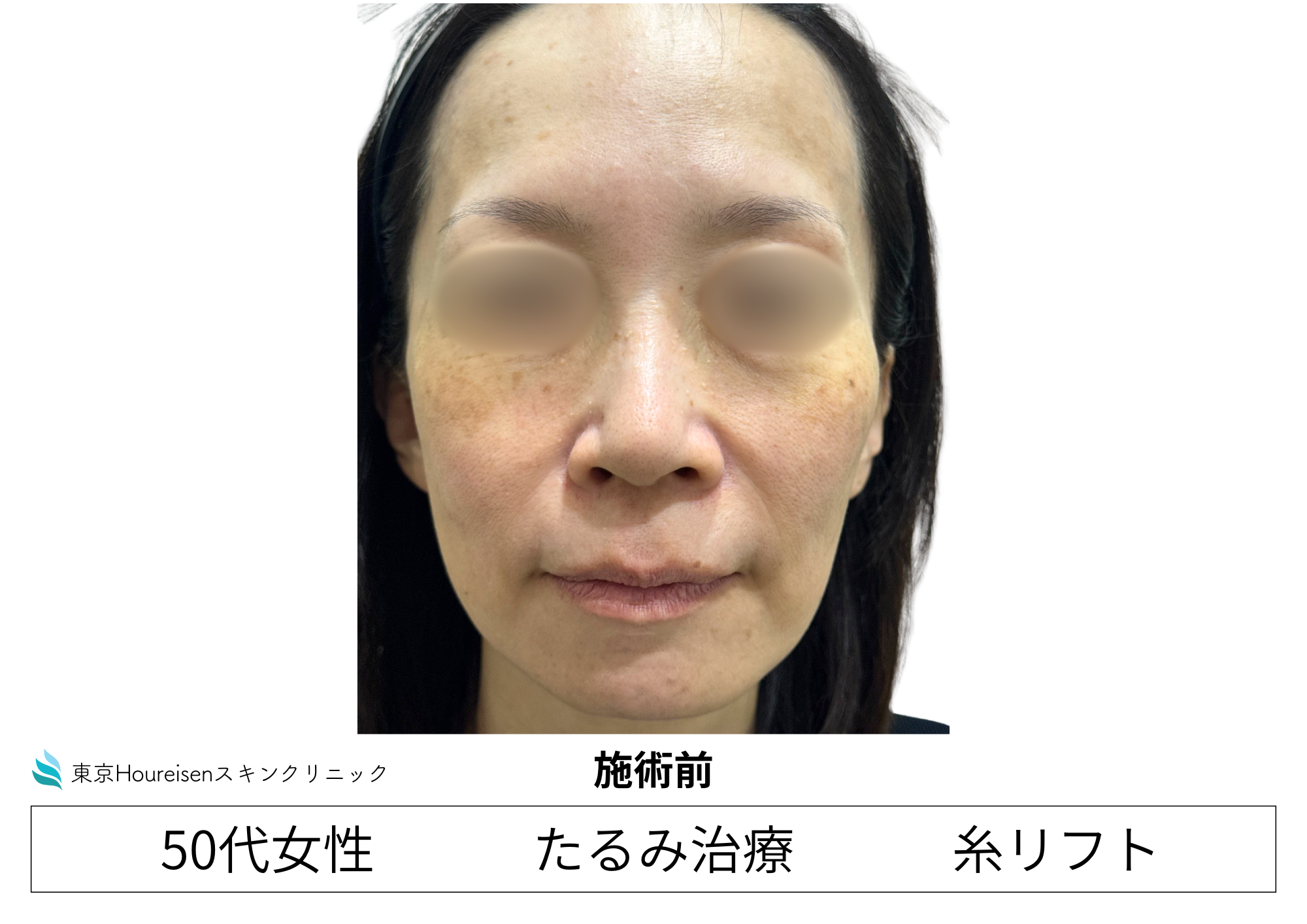 50代女性のPLCL糸リフト治療前 正面
