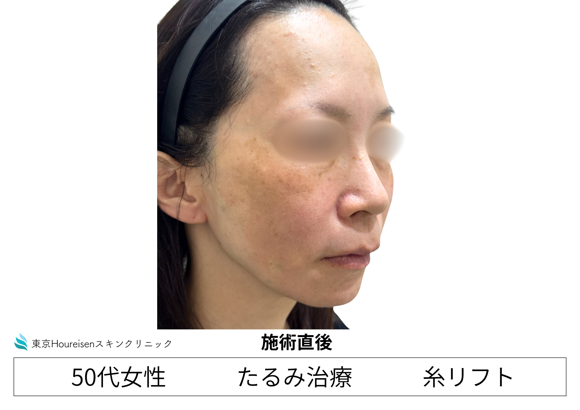 50代女性のPLCL糸リフト10本 施術直後 右側