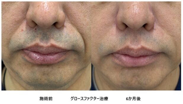 50代男性 症例9のほうれい線治療写真