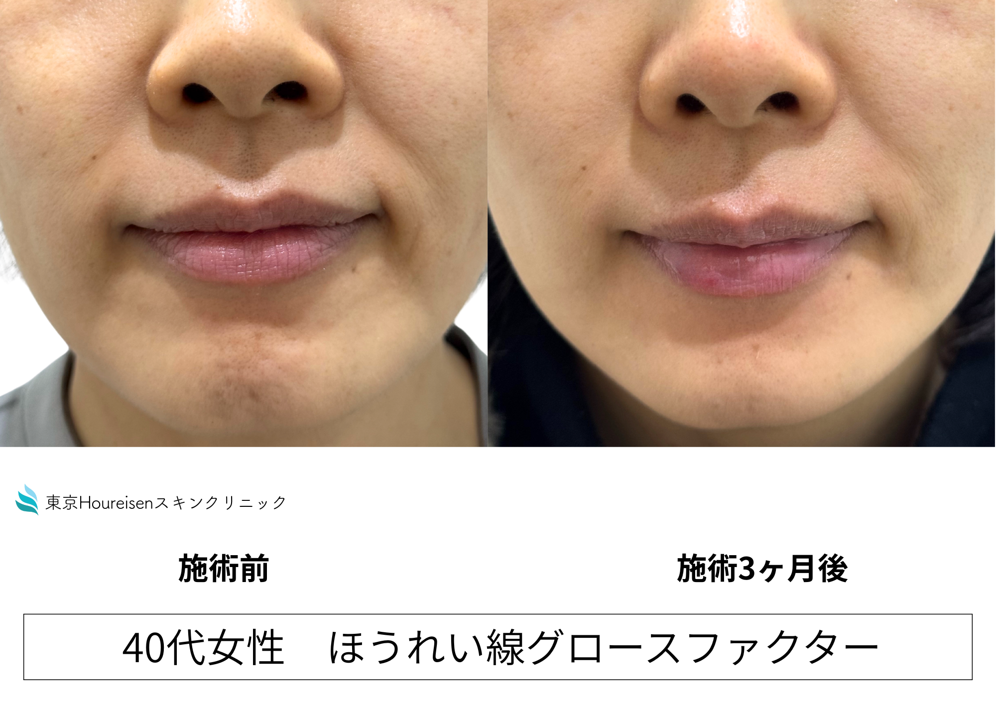 口元に力が入ってほうれい線が目立つ40代女性、グロースファクターで治療㊷