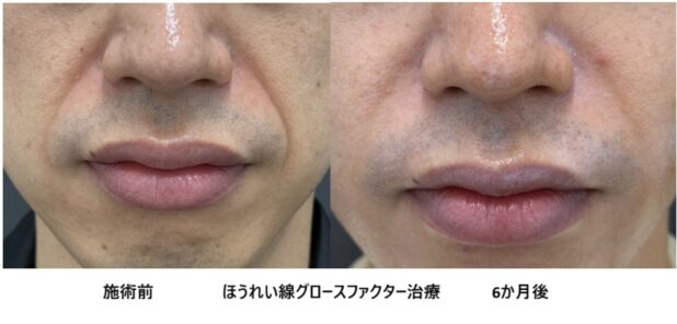 30代男性 症例11のほうれい線治療写真