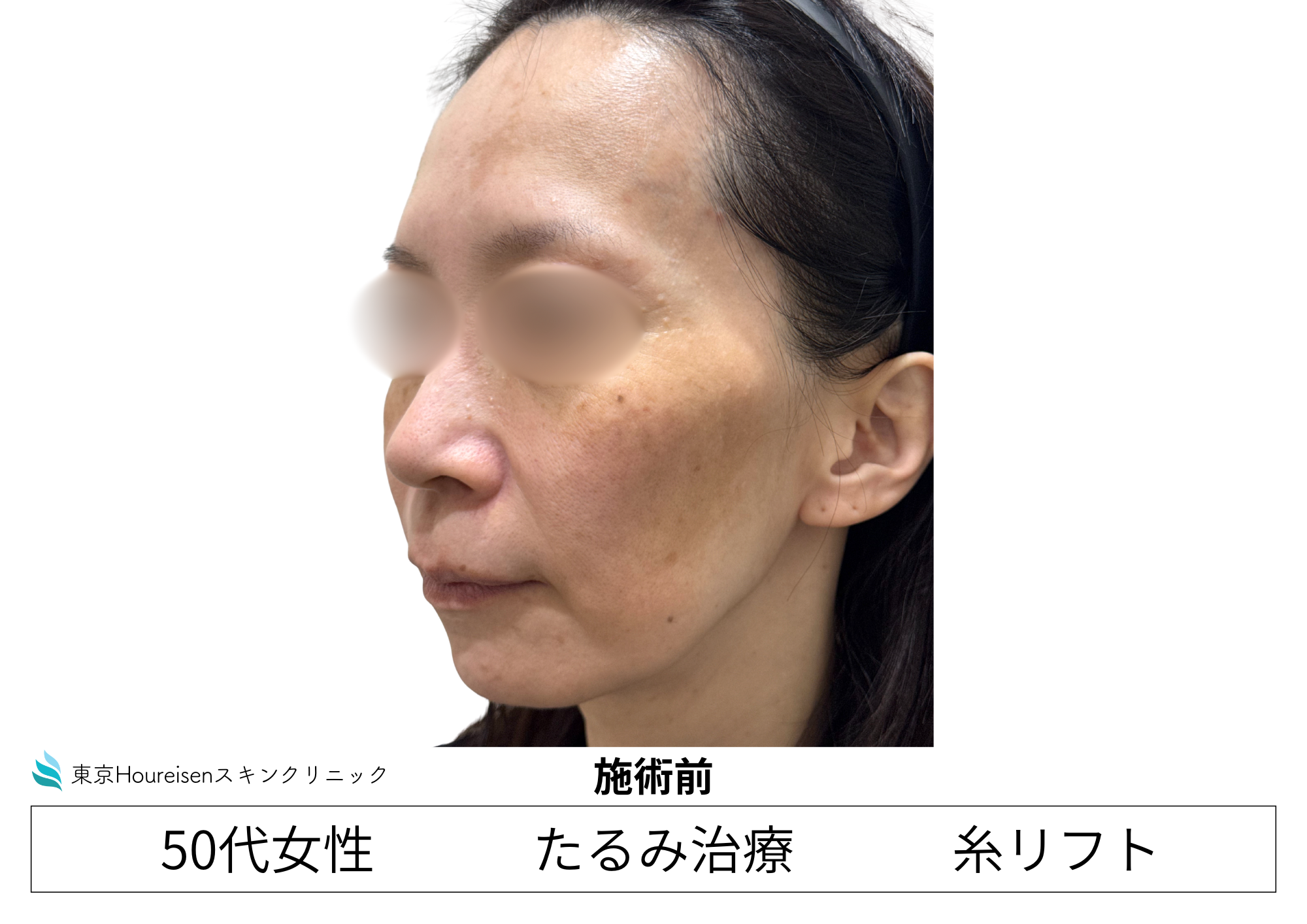 50代女性のPLCL糸リフト治療前 左側