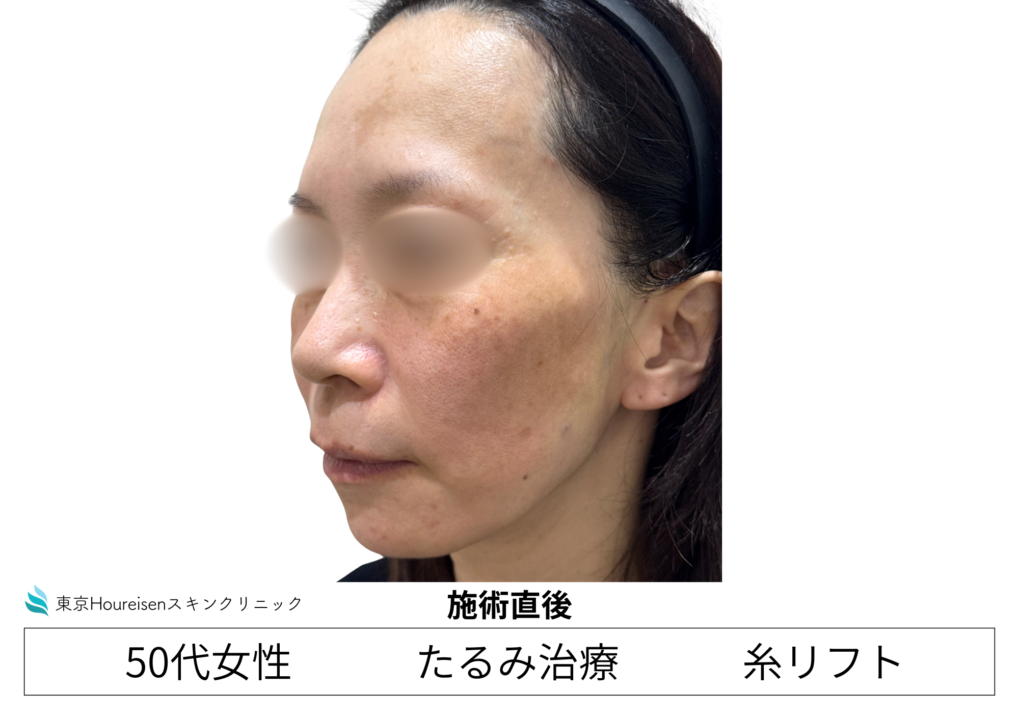 50代女性のPLCL糸リフト10本 施術直後 左側