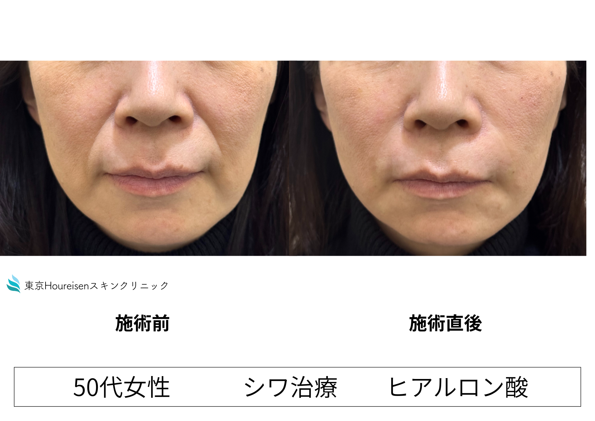 50代女性のたるんだほうれい線にヒアルロン酸治療で自然に改善させる症例㉗の症例写真