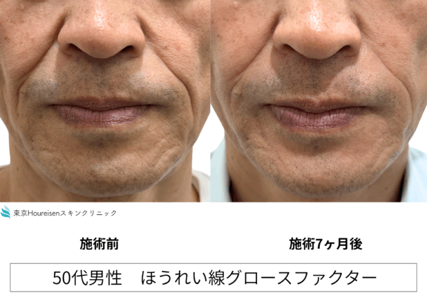 50代男性 症例10のほうれい線治療写真