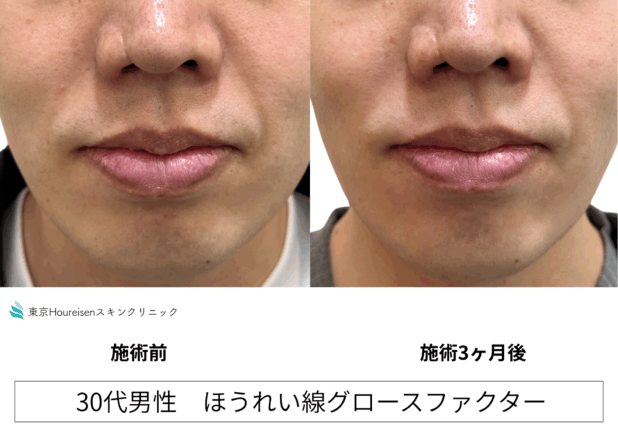 30代男性 症例12のほうれい線治療写真