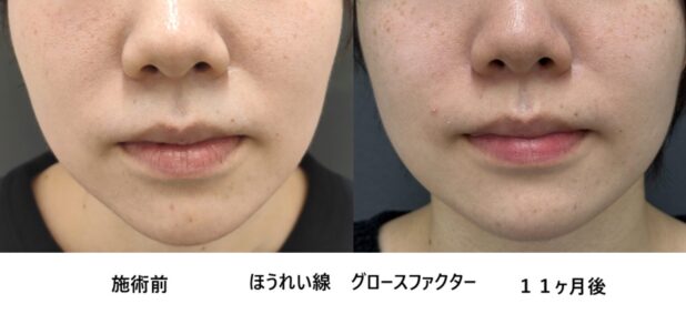 20代女性 症例18のほうれい線治療写真