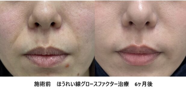 30代女性 症例47のほうれい線治療写真