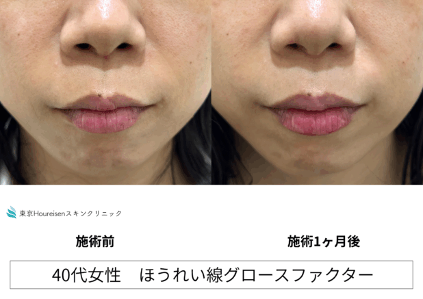 40代女性 症例49のほうれい線治療写真
