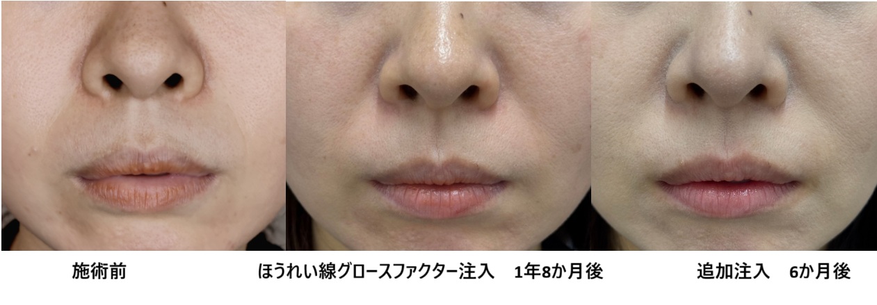 グロースファクターによるほうれい線治療 長期経過⑱（30代女性）