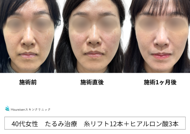 鼻横の影・くぼみはなぜできる?鼻翼基部の陥没とほうれい線の原因・改善方法を解説