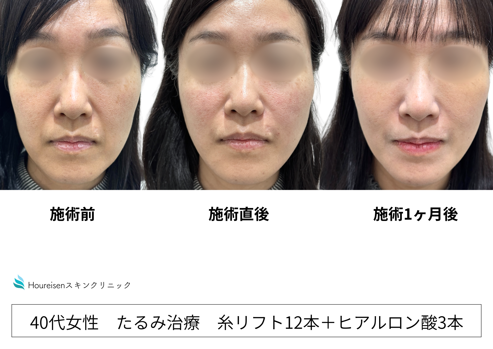 鼻横の影・くぼみはなぜできる?鼻翼基部の陥没とほうれい線の原因・改善方法を解説
