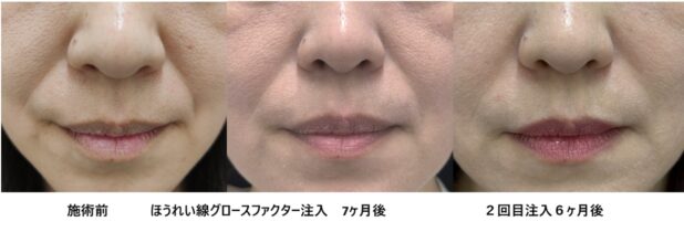 40代女性 症例46のほうれい線治療写真