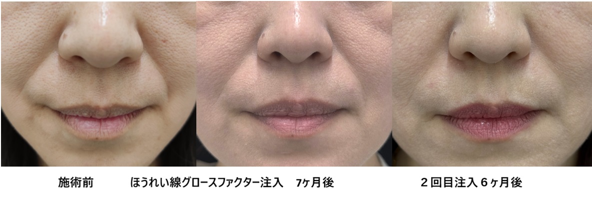ほうれい線重度の方　グロースファクター追加症例　40代女性㊻の症例写真
