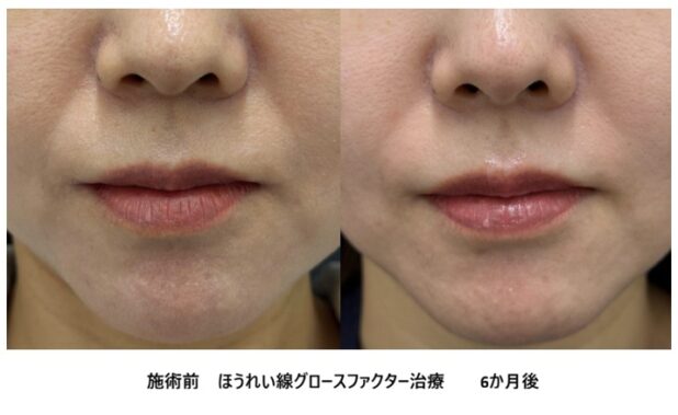 40代女性 症例47のほうれい線治療写真