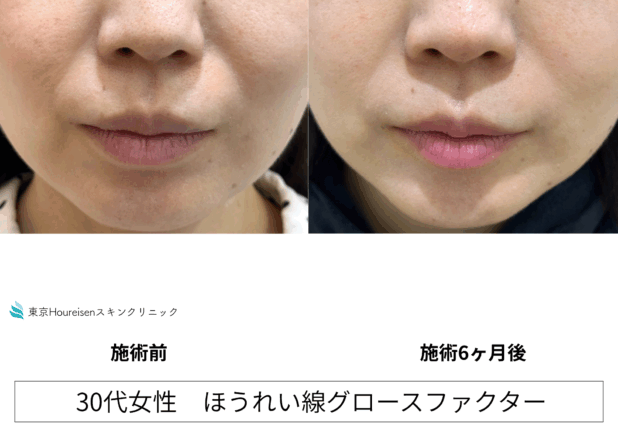 30代女性 症例48のほうれい線治療写真