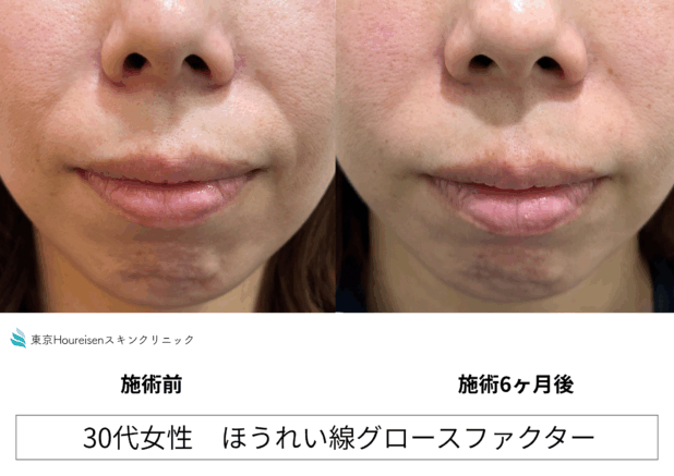 30代女性 症例46のほうれい線治療写真