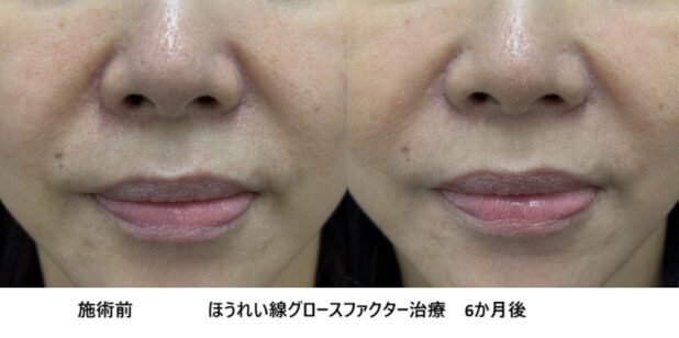50代女性 症例40のほうれい線治療写真