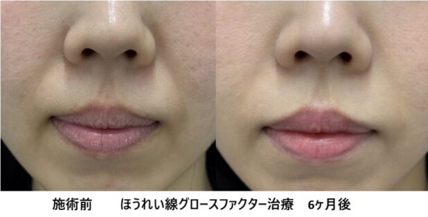 20代女性 症例17のほうれい線治療写真