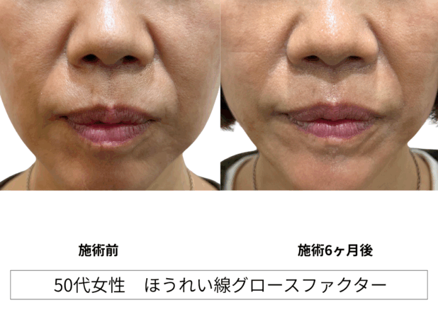 50代女性 症例38のほうれい線治療写真