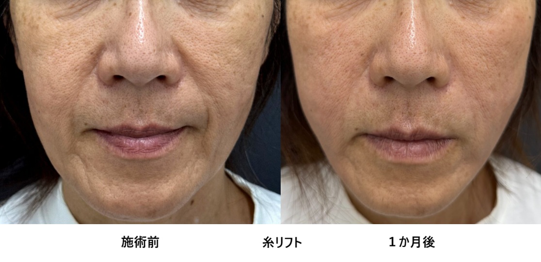 60代女性、糸リフト　フェイスライン　頬のたるみを撃退！㉚の症例写真