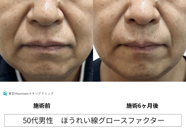 50代男性 症例8のほうれい線治療写真