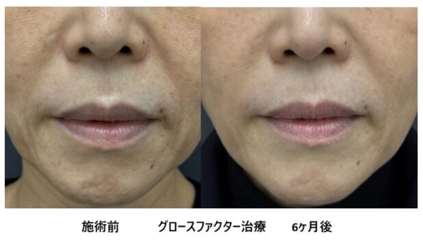 50代女性 症例41のほうれい線治療写真