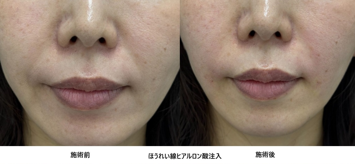 40代ほうれい線の悩みを解決!ヒアルロン酸注入で改善した実例と仕上がり症例㉛の症例写真
