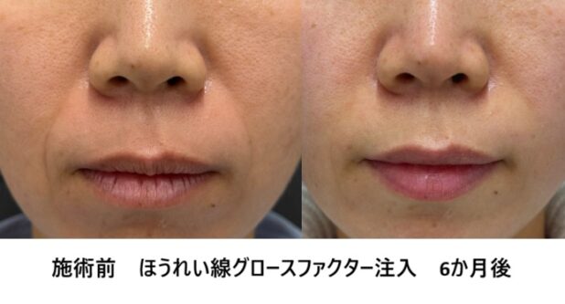 40代女性 症例52のほうれい線治療写真