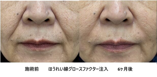 50代女性 症例42のほうれい線治療写真