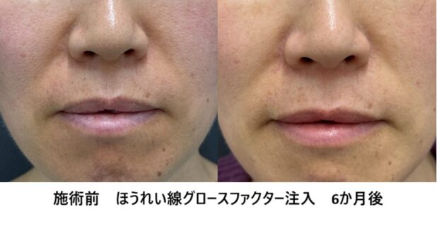 40代女性 症例51のほうれい線治療写真