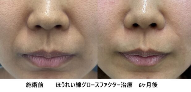 30代女性 症例54のほうれい線治療写真