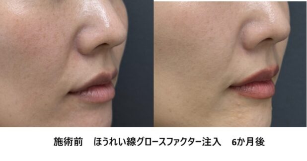 30代女性 症例51のほうれい線治療写真