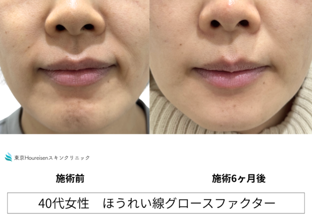 40代女性 症例42のほうれい線治療写真