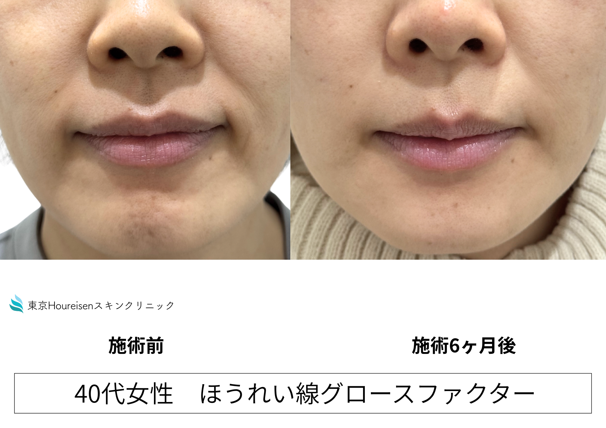 口元に力が入ってほうれい線が目立つ40代女性、グロースファクターで治療㊷