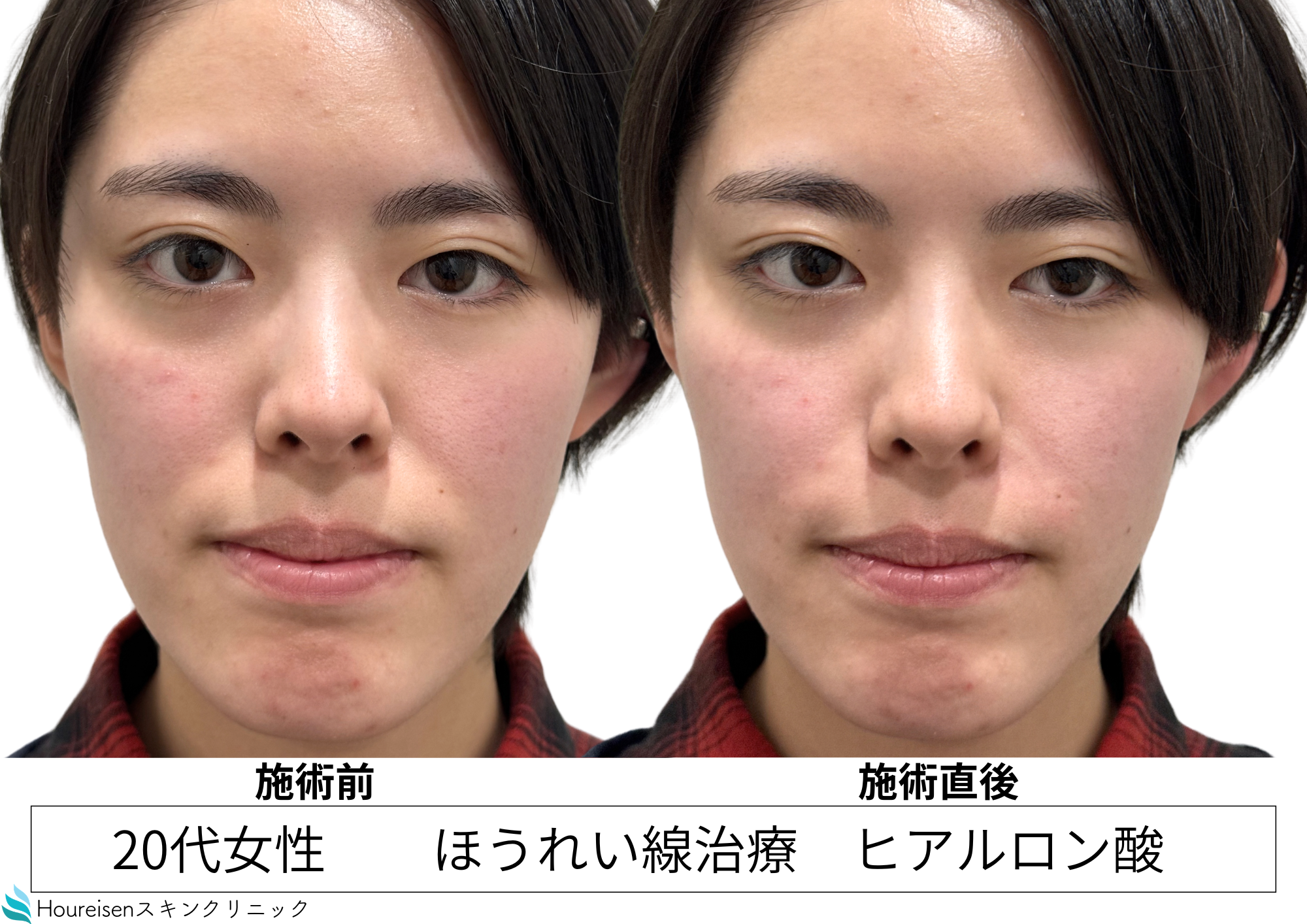 若い頃から気になる鼻横の窪みをヒアルロン酸注入治療で自然に改善 20代女性ヒアルロン酸症例 ㉟の症例写真