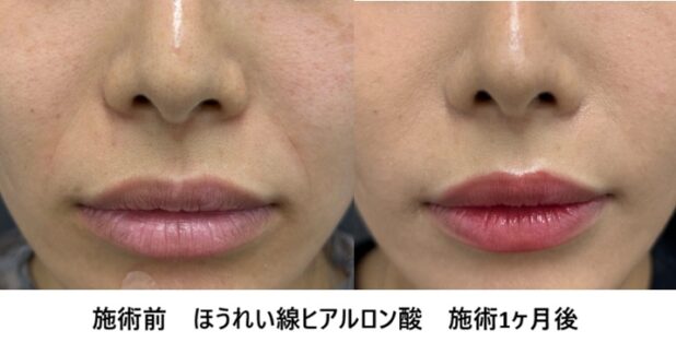 鼻横の影・くぼみはなぜできる?鼻翼基部の陥没とほうれい線の原因・改善方法を解説