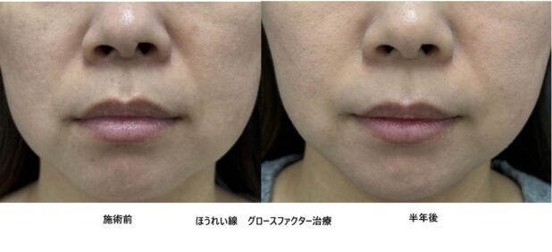 30代女性 症例50のほうれい線治療写真