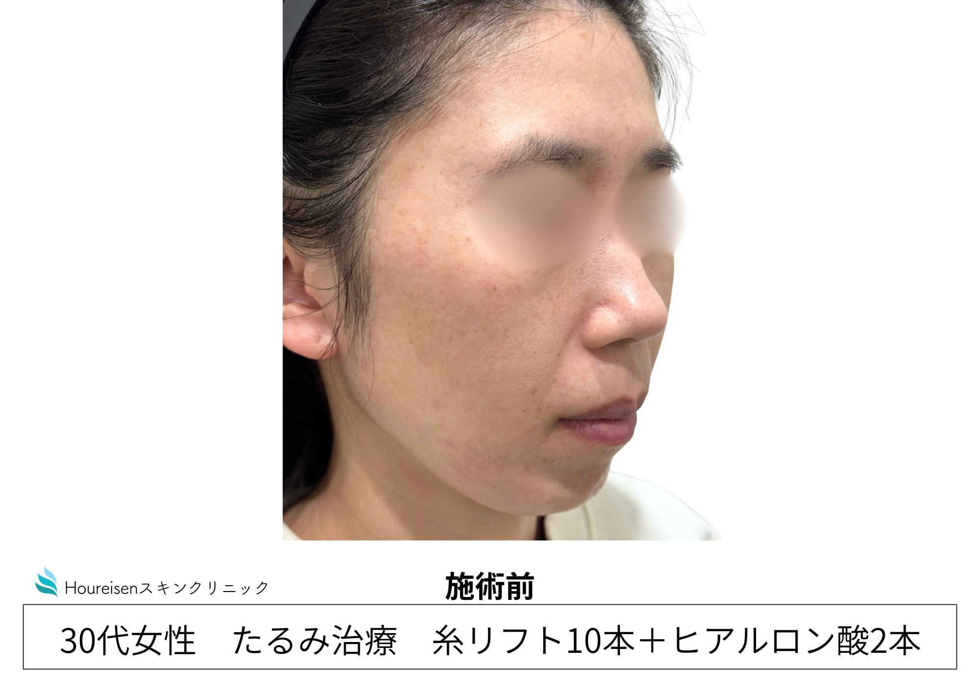 30代女性の糸リフトとヒアルロン酸施術前 右側