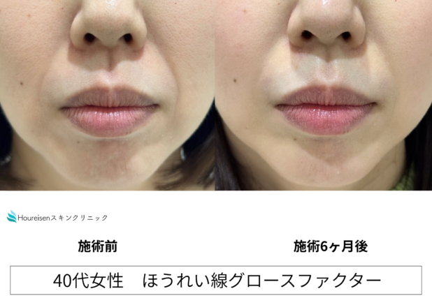 40代女性 症例53のほうれい線治療写真